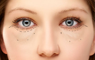lower-eyelid-blepharoplasty
